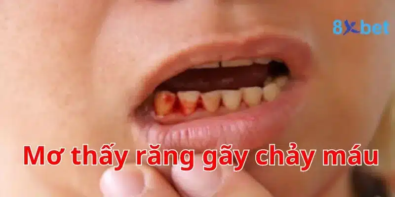 Mơ thấy răng gãy chảy máu